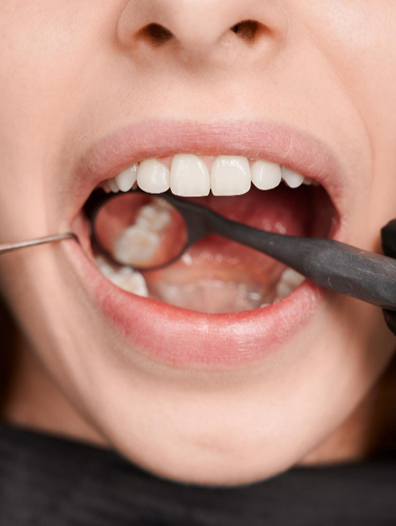 Teeth Whitening