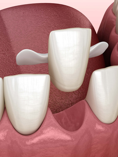 Dental Bridge