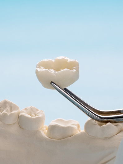 Dental Crown