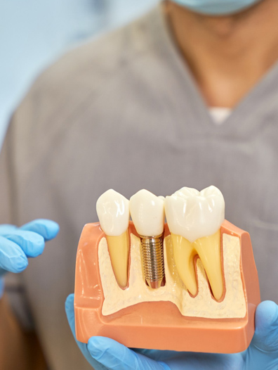 Dental Implant