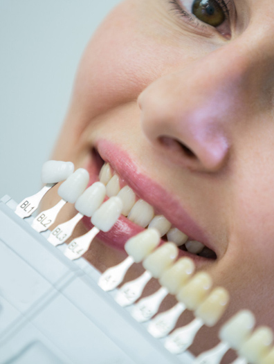 Veneers